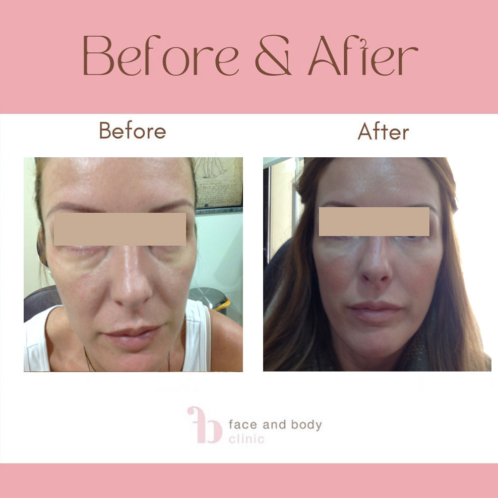 Πρίν και μετά απο επέμβαση με υαλουρονικό οξύ στα μέτωπο - Face and Body Clinic