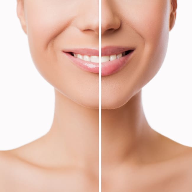 Πρίν και μετά απο επέμβαση με υαλουρονικό οξύ - Face and Body Clinic
