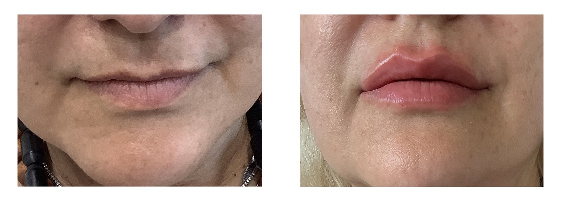Πρίν και μετά απο επέμβαση με υαλουρονικό οξύ στα χείλη - Face and Body Clinic