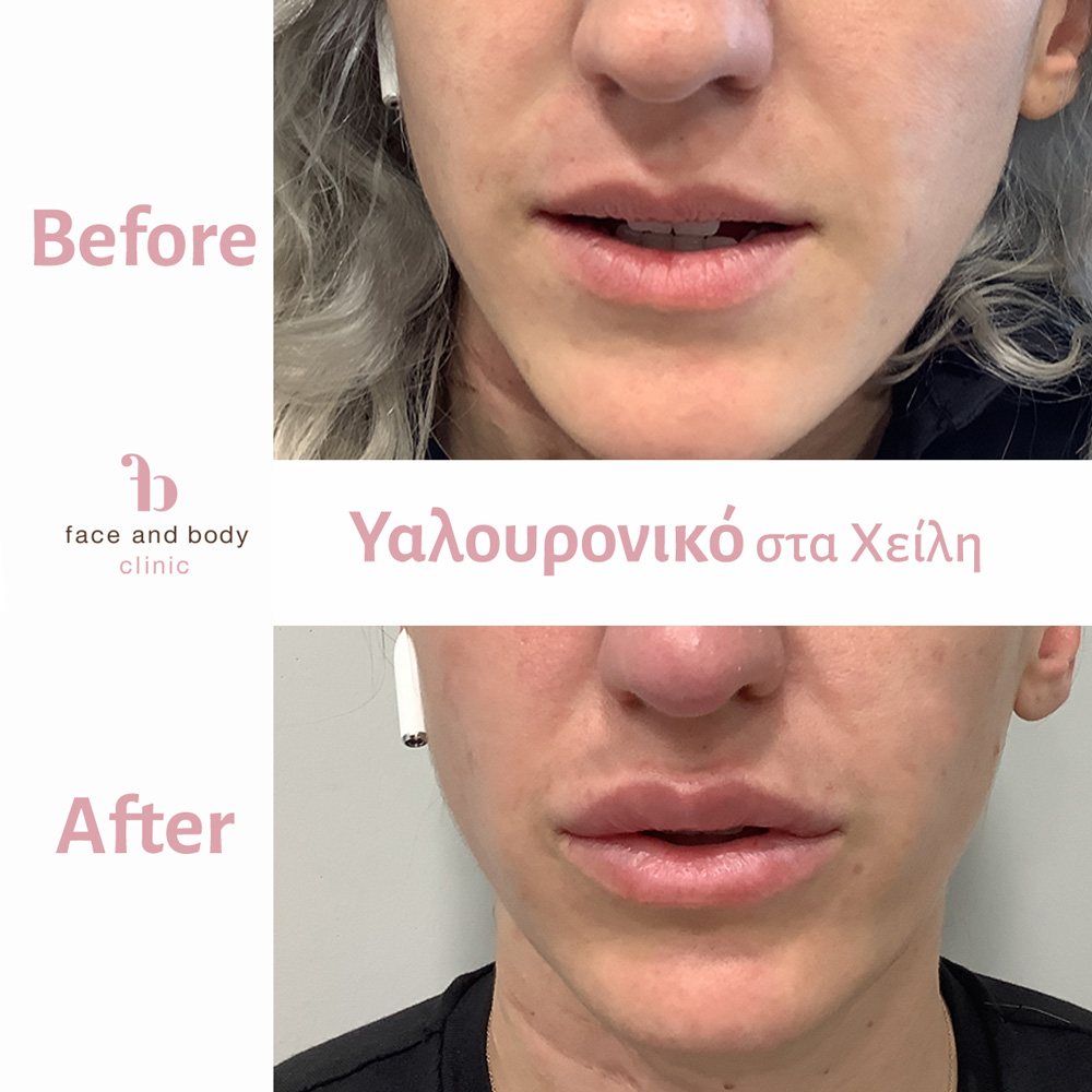 πριν και μετά απο θεραπεία με Υαλουρονικό στα χείλη στο face and body clinic